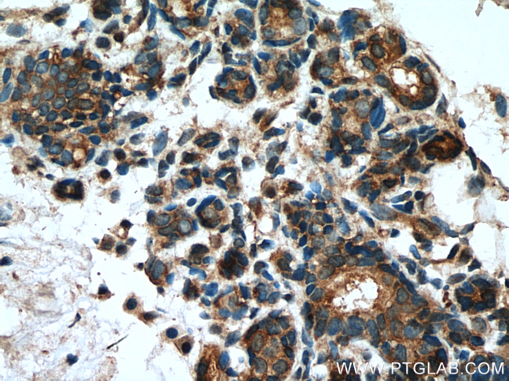 Immunohistochemistry (IHC) staining of human breast hyperplasia tissue using IMPDH2 Monoclonal antibody (67663-1-Ig)