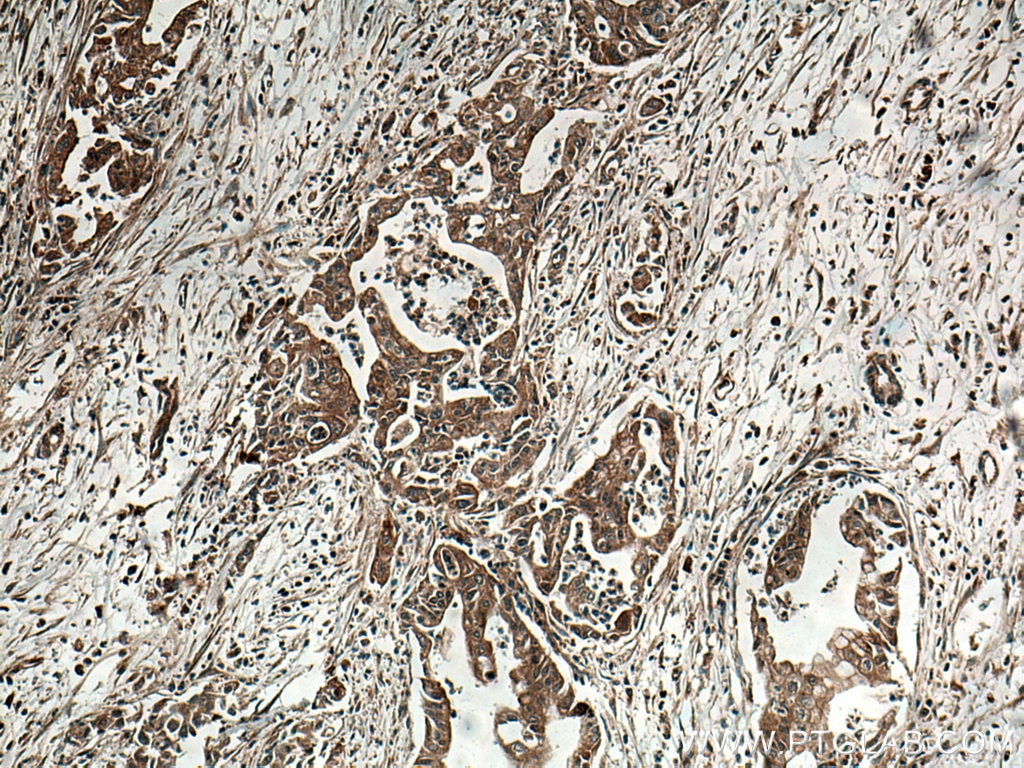 Immunohistochemistry (IHC) staining of human pancreas cancer tissue using INA Monoclonal antibody (67120-1-Ig)