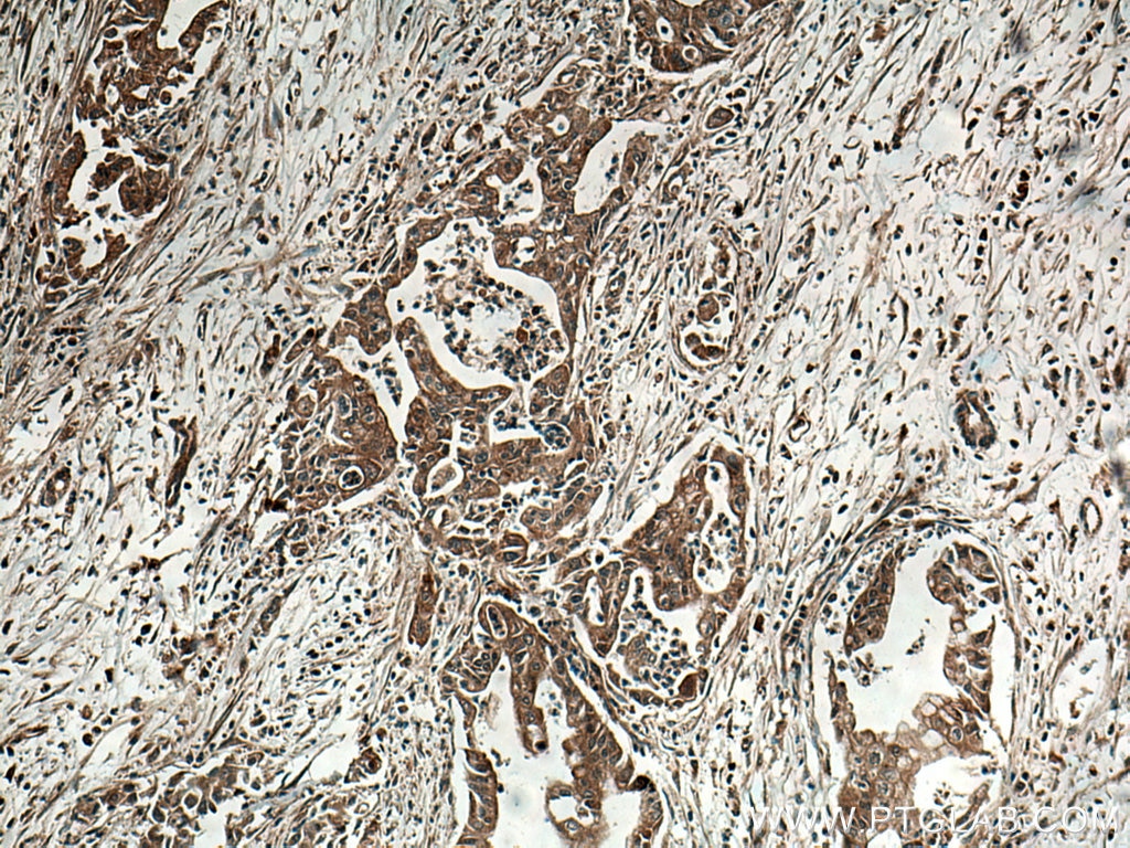 IHC staining of human pancreas cancer using 67120-1-Ig