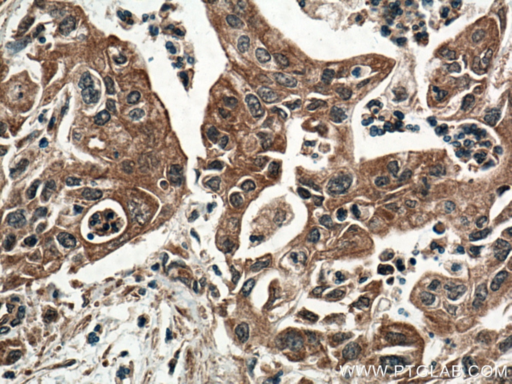 Immunohistochemistry (IHC) staining of human pancreas cancer tissue using INA Monoclonal antibody (67120-1-Ig)