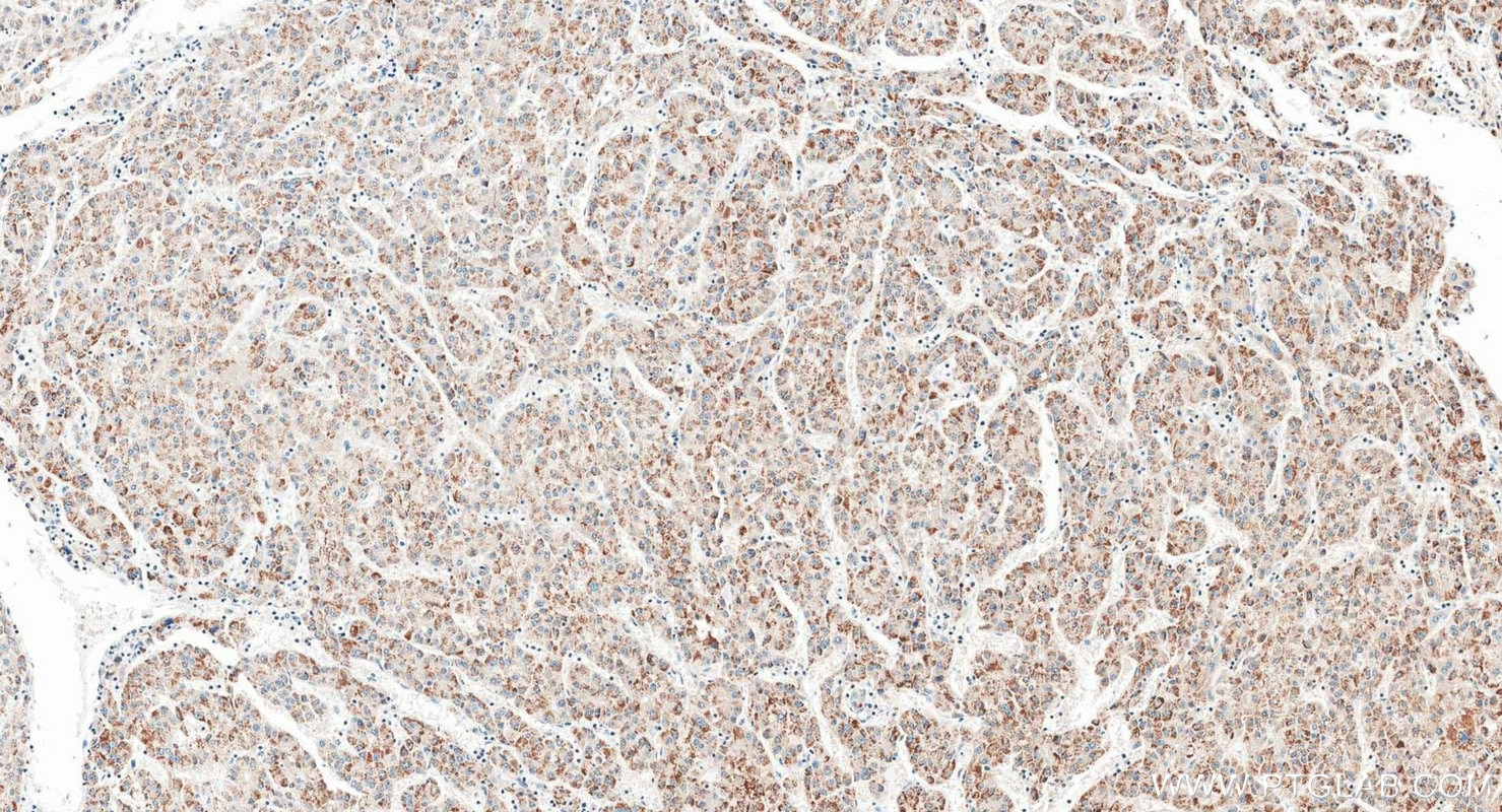 Immunohistochemistry (IHC) staining of human liver cancer tissue using INE1 Polyclonal antibody (21340-1-AP)