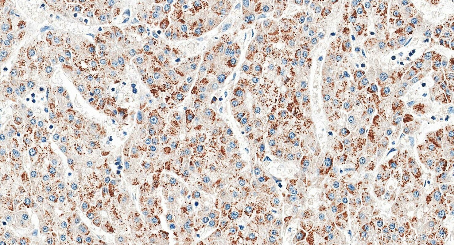 Immunohistochemistry (IHC) staining of human liver cancer tissue using INE1 Polyclonal antibody (21340-1-AP)