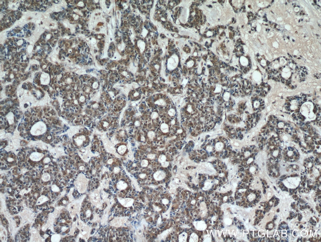 Immunohistochemistry (IHC) staining of human cervical cancer tissue using ING2 Polyclonal antibody (11560-1-AP)