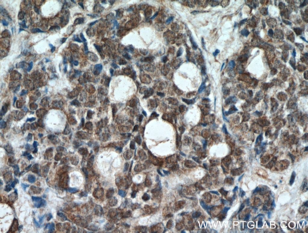 Immunohistochemistry (IHC) staining of human cervical cancer tissue using ING2 Polyclonal antibody (11560-1-AP)