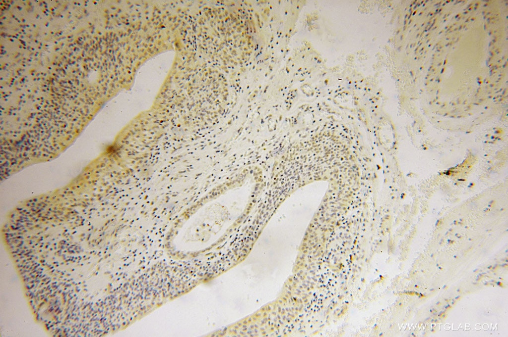 Immunohistochemistry (IHC) staining of human colon cancer tissue using ING2 Polyclonal antibody (11560-1-AP)