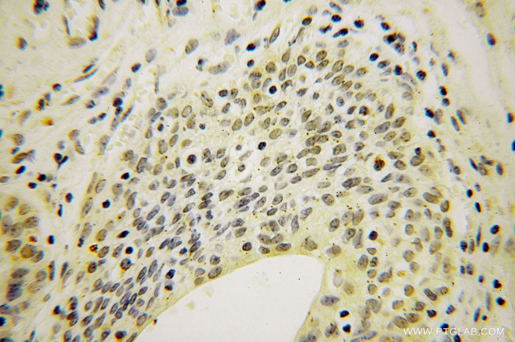 Immunohistochemistry (IHC) staining of human colon cancer tissue using ING2 Polyclonal antibody (11560-1-AP)