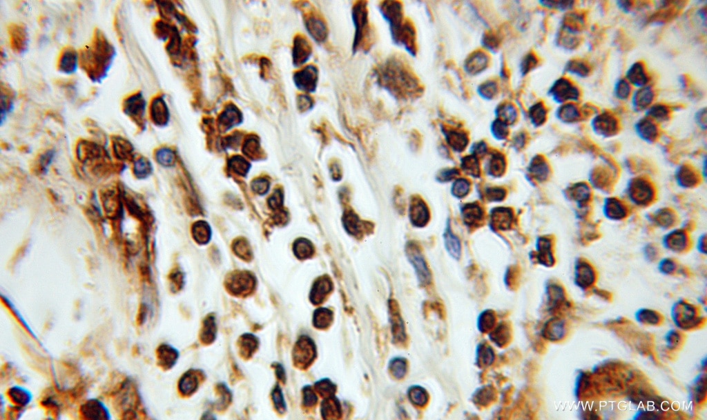 Immunohistochemistry (IHC) staining of human breast cancer tissue using ING3 Polyclonal antibody (10905-1-AP)