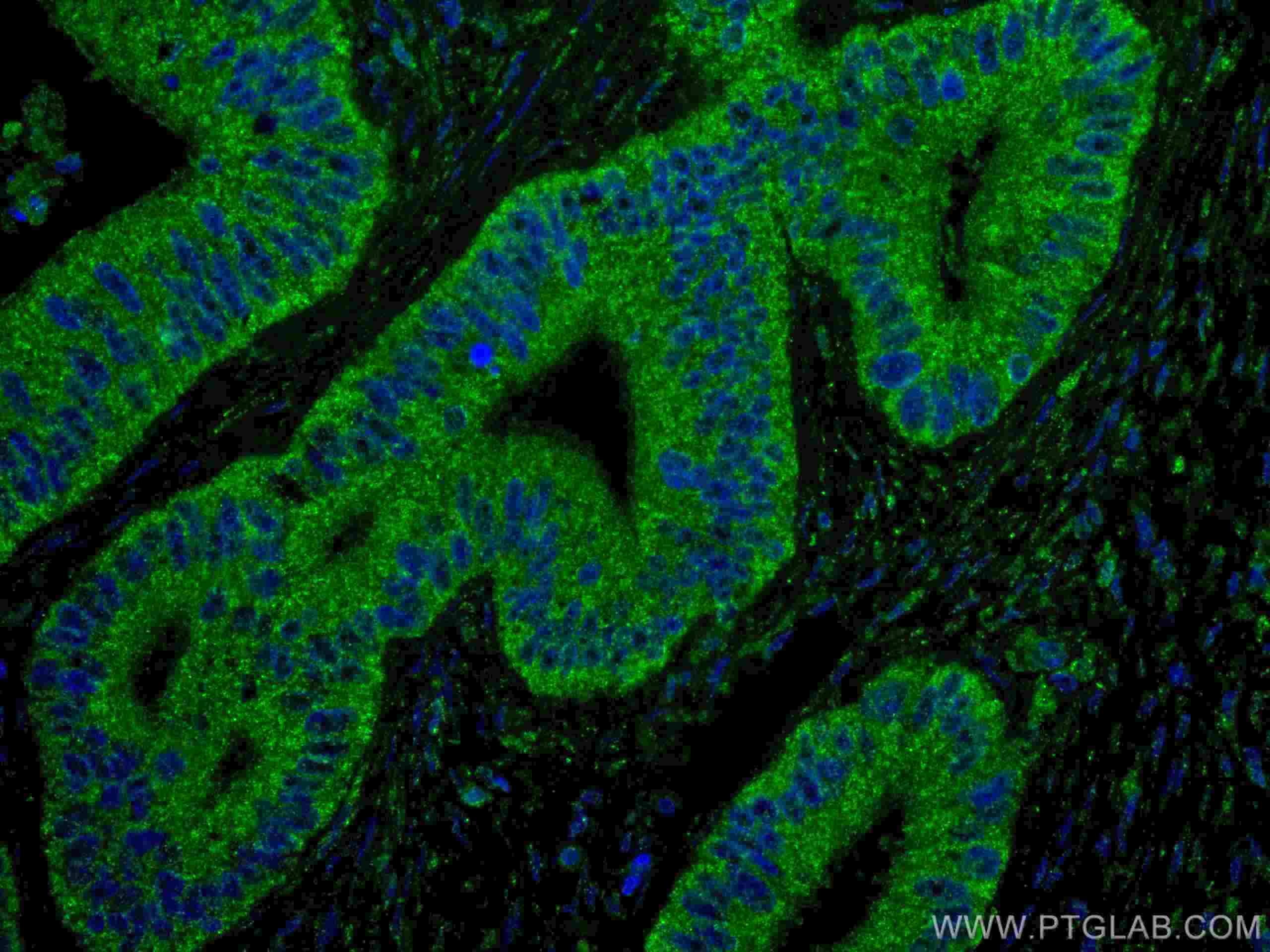 Immunofluorescence (IF) / fluorescent staining of human colon cancer tissue using ING4 Monoclonal antibody (67754-1-Ig)