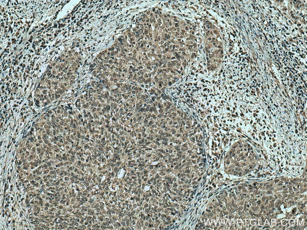 Immunohistochemistry (IHC) staining of human cervical cancer tissue using ING4 Monoclonal antibody (67754-1-Ig)