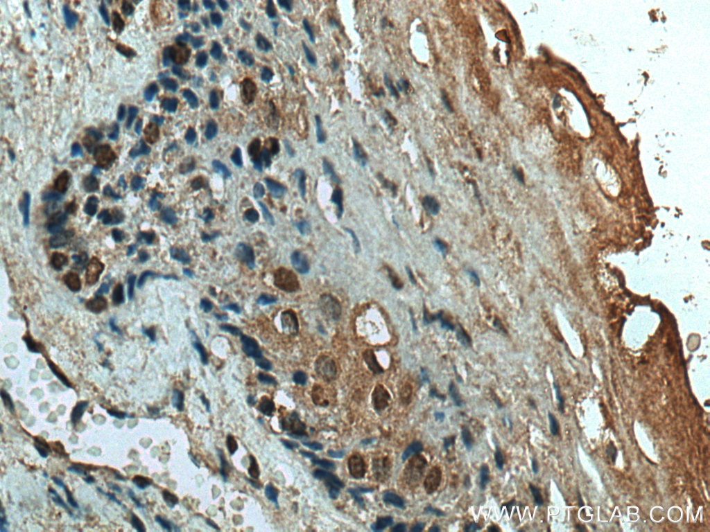 Immunohistochemistry (IHC) staining of human cervical cancer tissue using ING4 Monoclonal antibody (67754-1-Ig)
