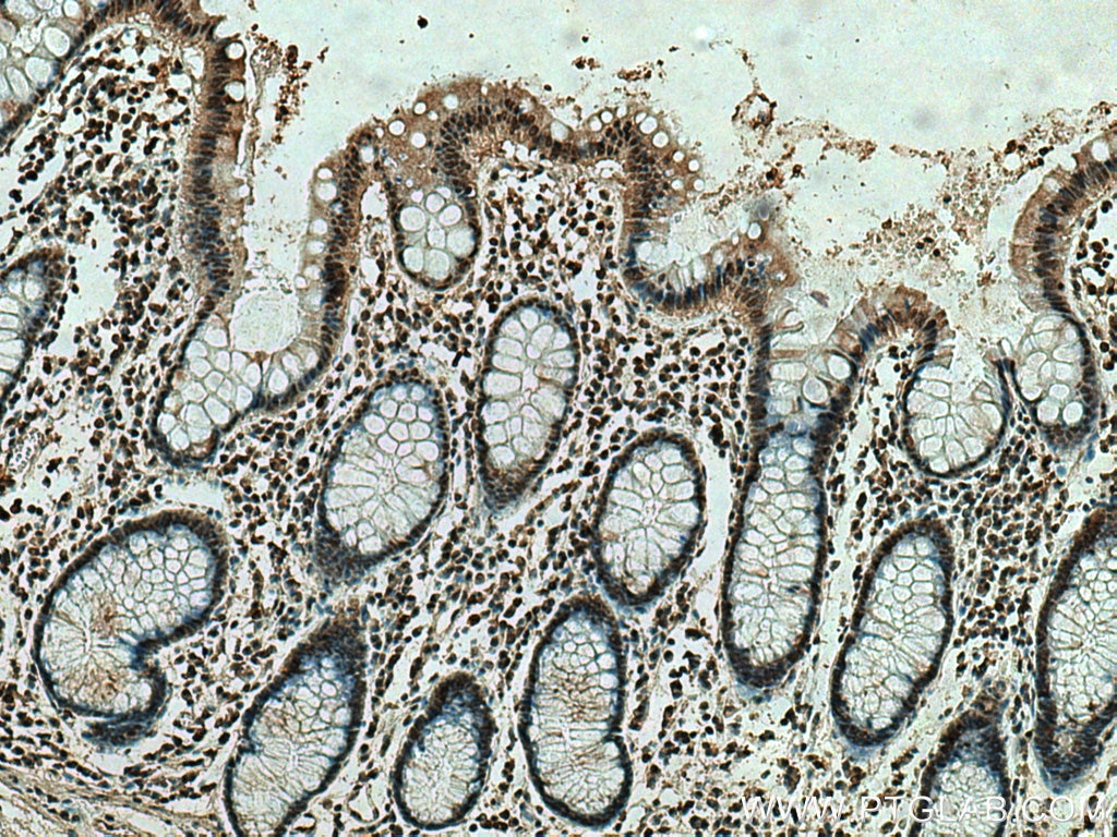 Immunohistochemistry (IHC) staining of human colon cancer tissue using ING4 Monoclonal antibody (67754-1-Ig)