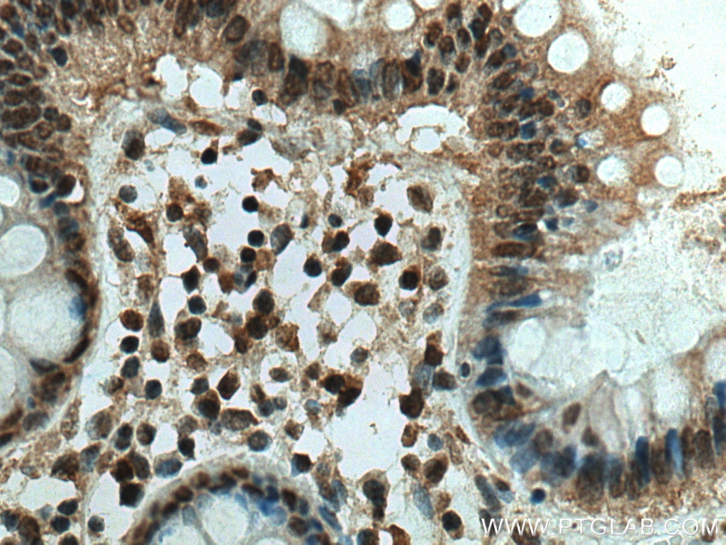 Immunohistochemistry (IHC) staining of human colon cancer tissue using ING4 Monoclonal antibody (67754-1-Ig)