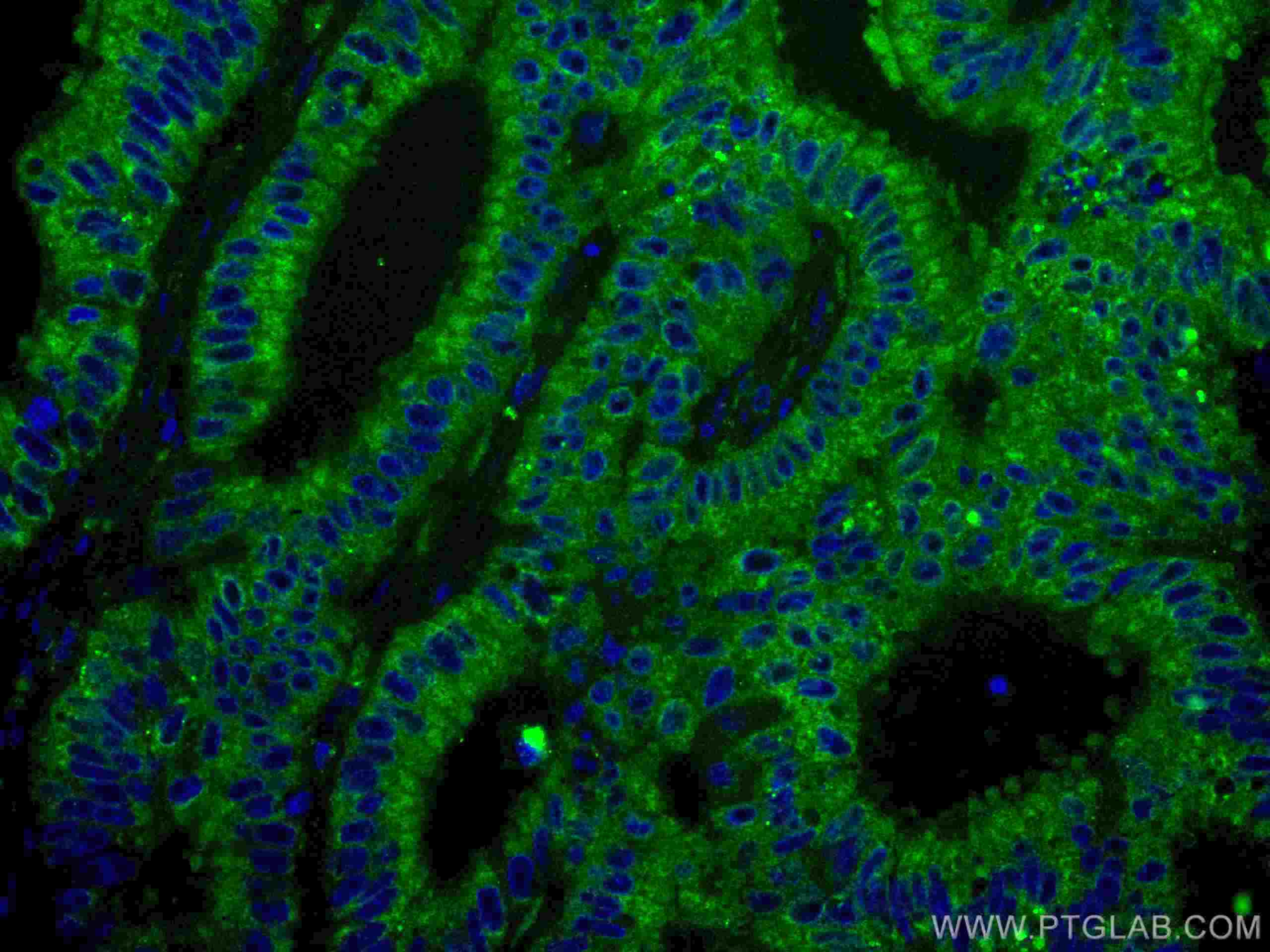 Immunofluorescence (IF) / fluorescent staining of human colon cancer tissue using CoraLite® Plus 488-conjugated ING4 Monoclonal anti (CL488-67754)