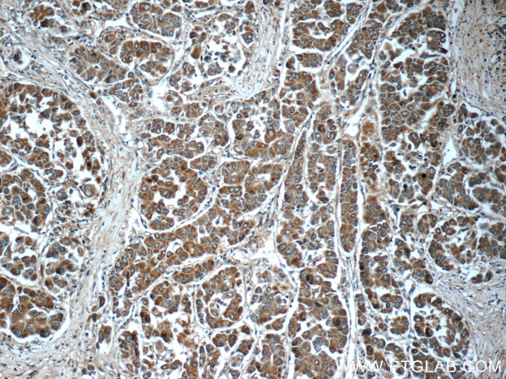 Immunohistochemistry (IHC) staining of human liver cancer tissue using ING4-specific Polyclonal antibody (16188-1-AP)