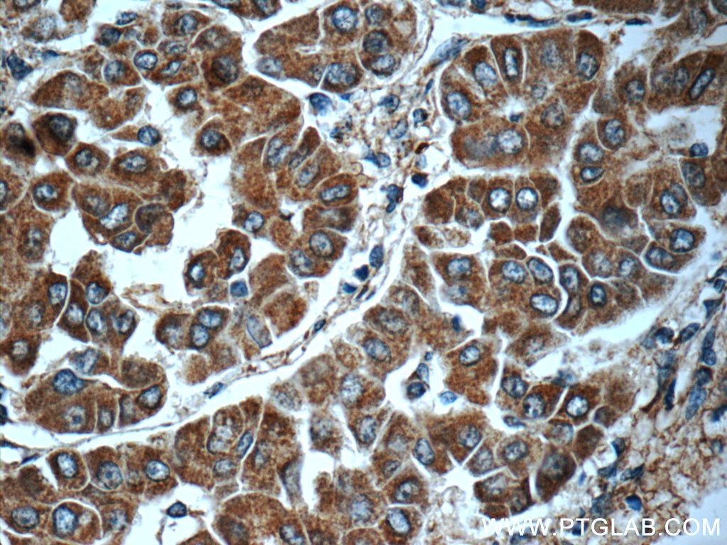 Immunohistochemistry (IHC) staining of human liver cancer tissue using ING4-specific Polyclonal antibody (16188-1-AP)