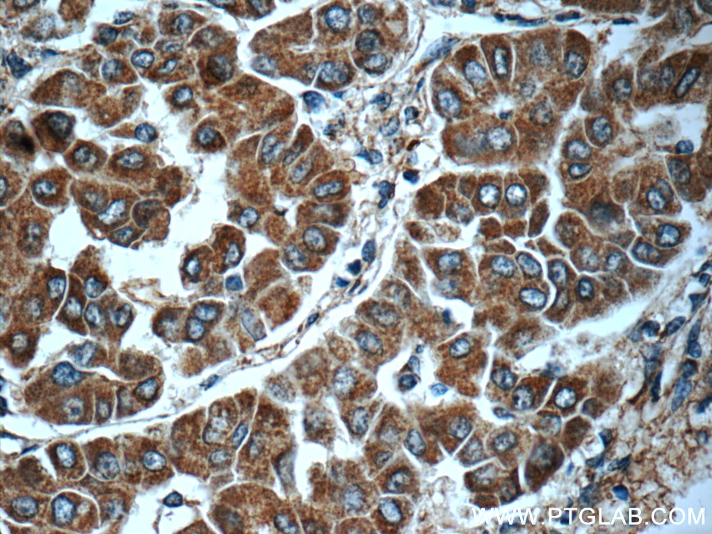 IHC staining of human liver cancer using 16188-1-AP