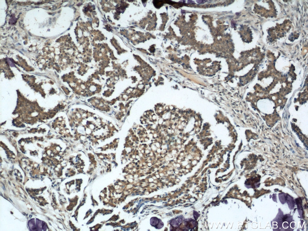 IHC staining of human ovary tumor using 10665-1-AP