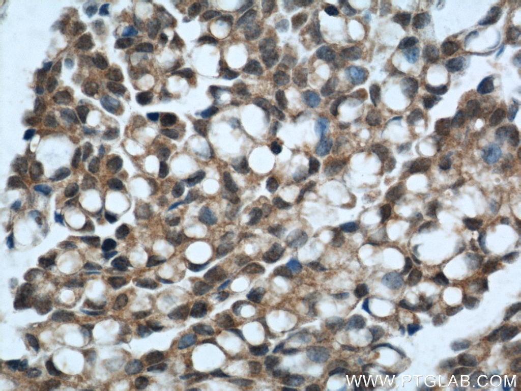 Immunohistochemistry (IHC) staining of human ovary tumor tissue using ING5 Polyclonal antibody (10665-1-AP)