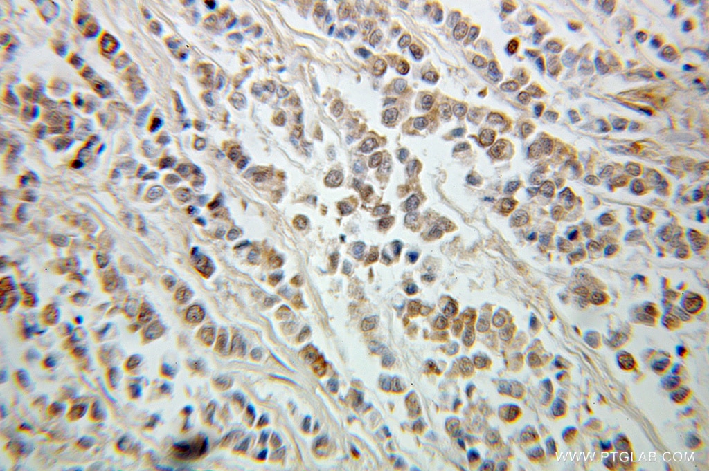 IHC staining of human colon cancer using 10665-1-AP