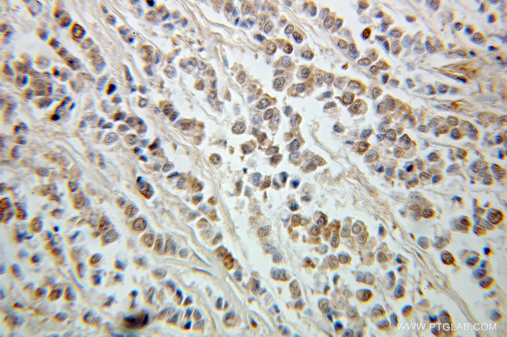 Immunohistochemistry (IHC) staining of human colon cancer tissue using ING5 Polyclonal antibody (10665-1-AP)