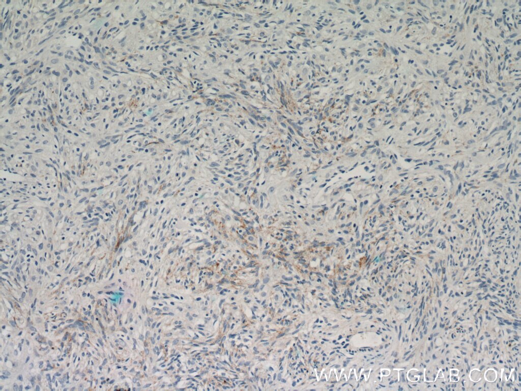 Immunohistochemistry (IHC) staining of human ovary tumor tissue using Inhibin Alpha Polyclonal antibody (10609-1-AP)