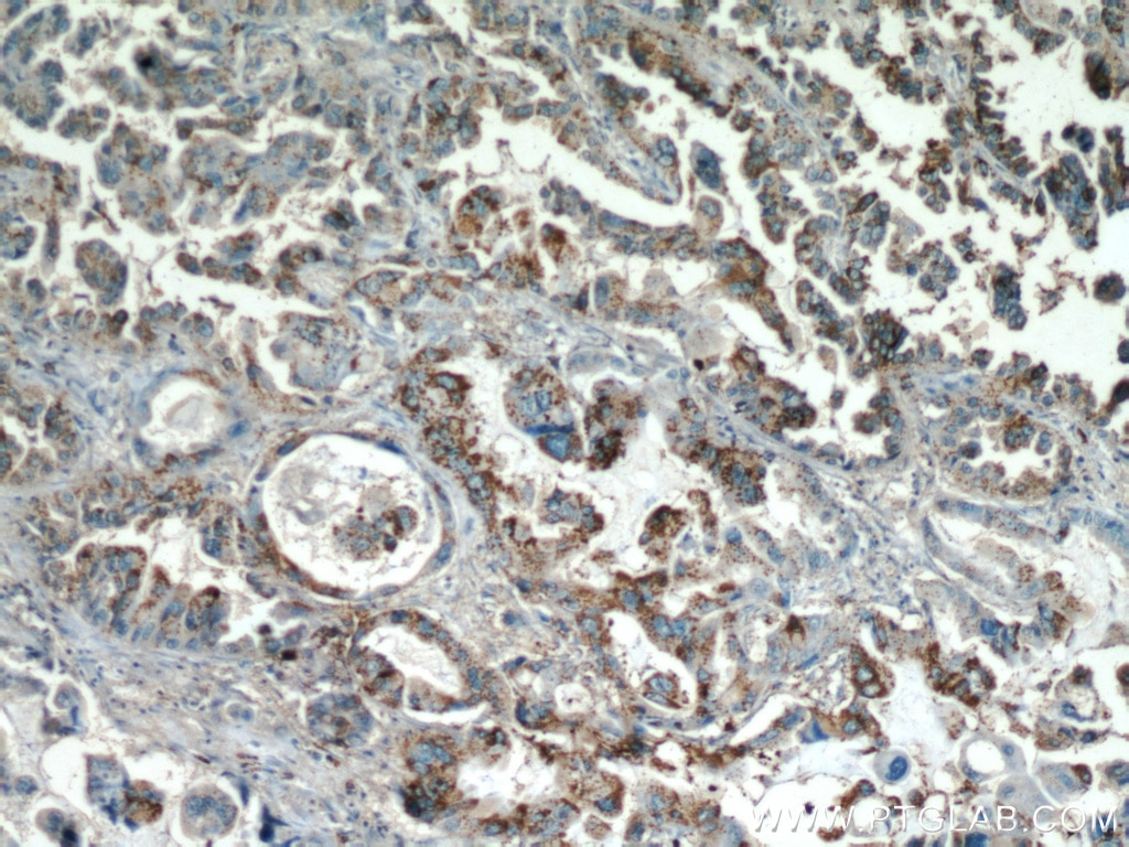 Immunohistochemistry (IHC) staining of human lung cancer tissue using Inhibin Beta A Polyclonal antibody (10651-1-AP)