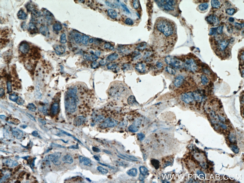 Immunohistochemistry (IHC) staining of human lung cancer tissue using Inhibin Beta A Polyclonal antibody (10651-1-AP)