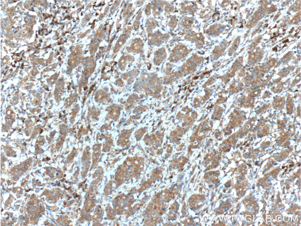 Immunohistochemistry (IHC) staining of human stomach cancer tissue using Inhibin beta A-Specific Monoclonal antibody (60352-1-Ig)