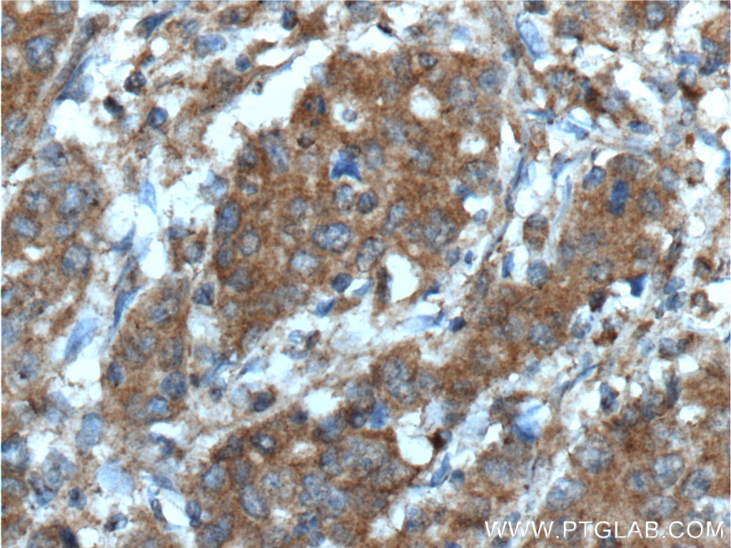 Immunohistochemistry (IHC) staining of human stomach cancer tissue using Inhibin beta A-Specific Monoclonal antibody (60352-1-Ig)
