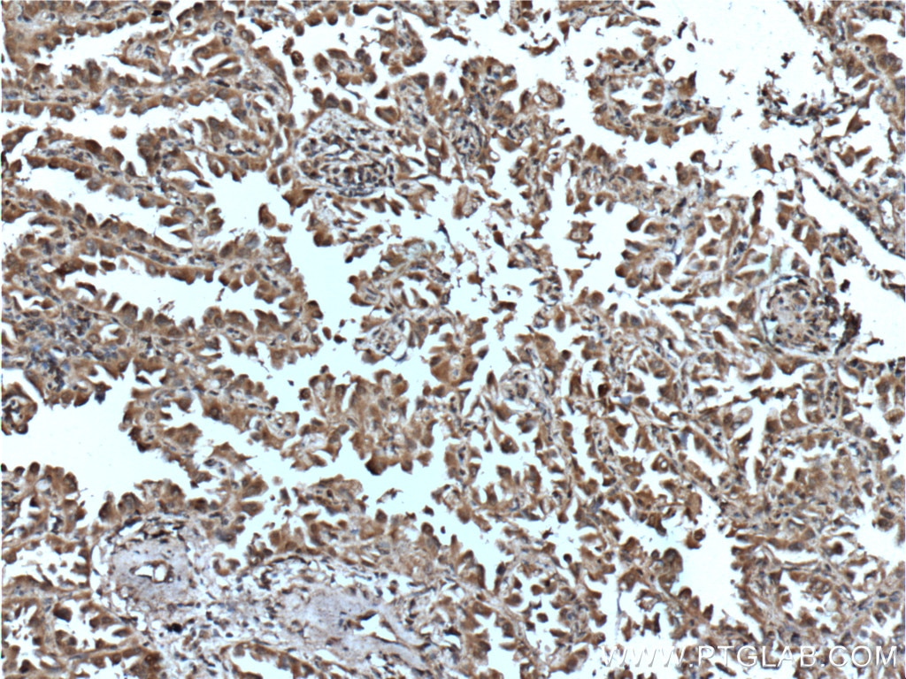 Immunohistochemistry (IHC) staining of human lung cancer tissue using Inhibin beta A-Specific Monoclonal antibody (60352-1-Ig)