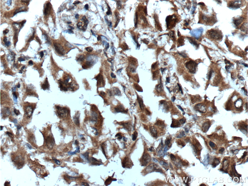 Immunohistochemistry (IHC) staining of human lung cancer tissue using Inhibin beta A-Specific Monoclonal antibody (60352-1-Ig)