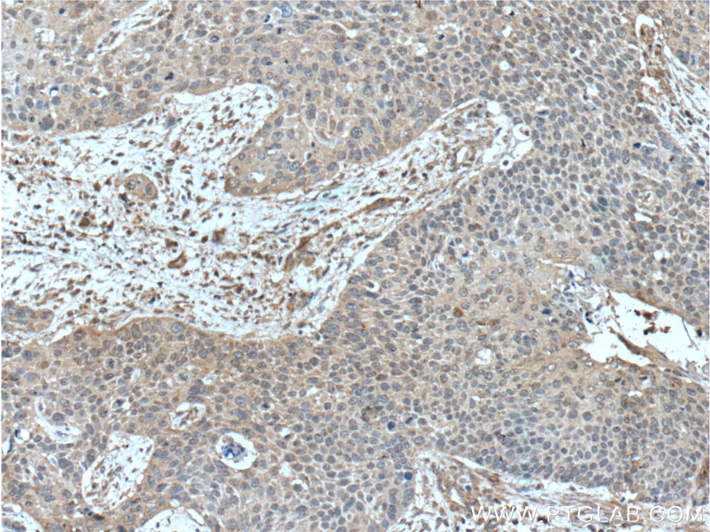 Immunohistochemistry (IHC) staining of human oesophagus cancer tissue using Inhibin beta A-Specific Monoclonal antibody (60352-1-Ig)