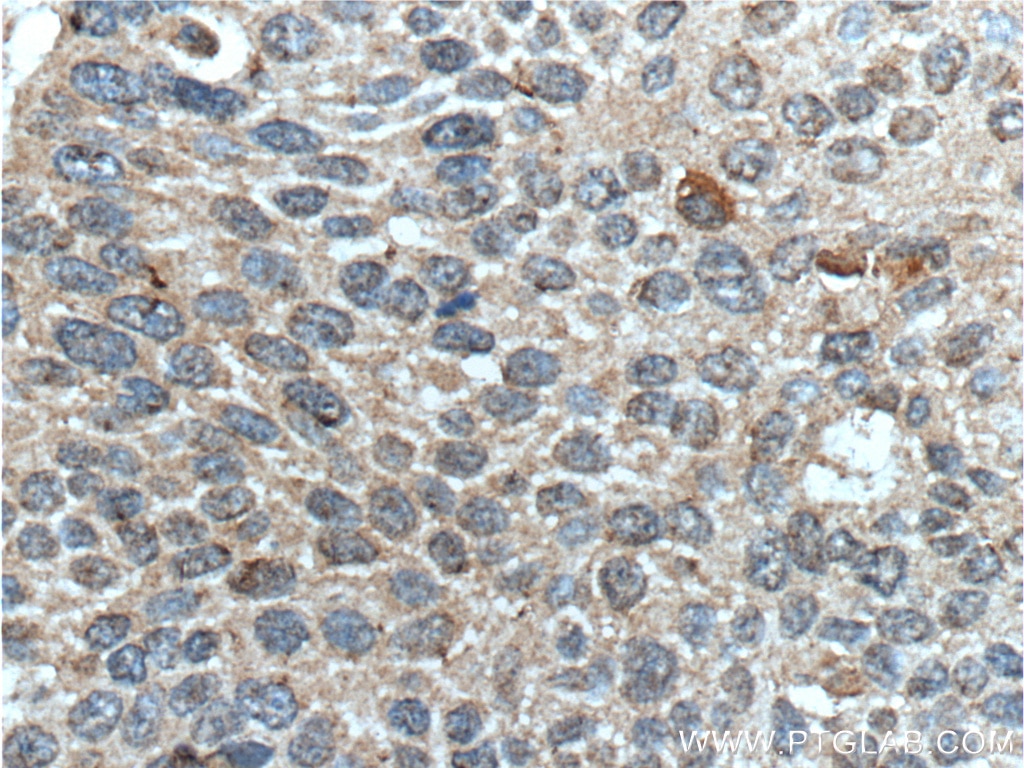 IHC staining of human oesophagus cancer using 60352-1-Ig