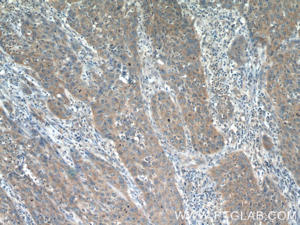 Immunohistochemistry (IHC) staining of human cervical cancer tissue using INHBC Polyclonal antibody (24196-1-AP)