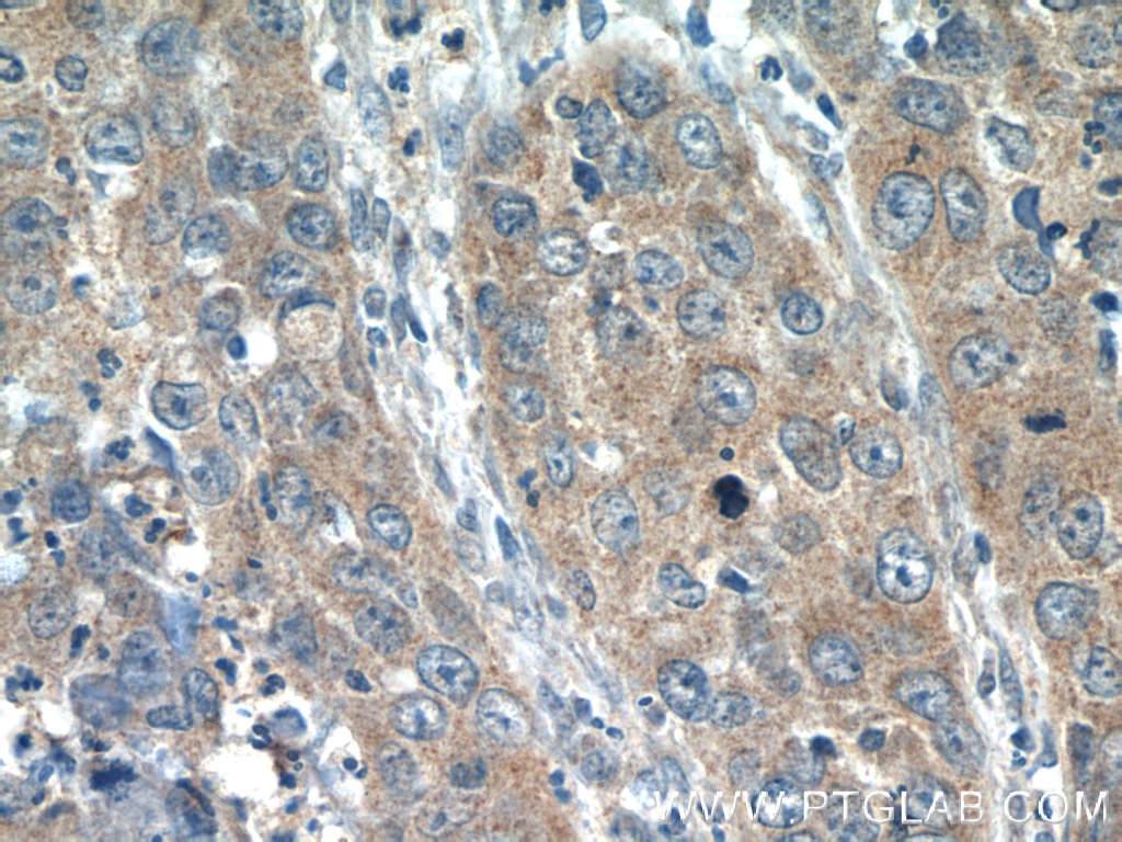 Immunohistochemistry (IHC) staining of human cervical cancer tissue using INHBC Polyclonal antibody (24196-1-AP)