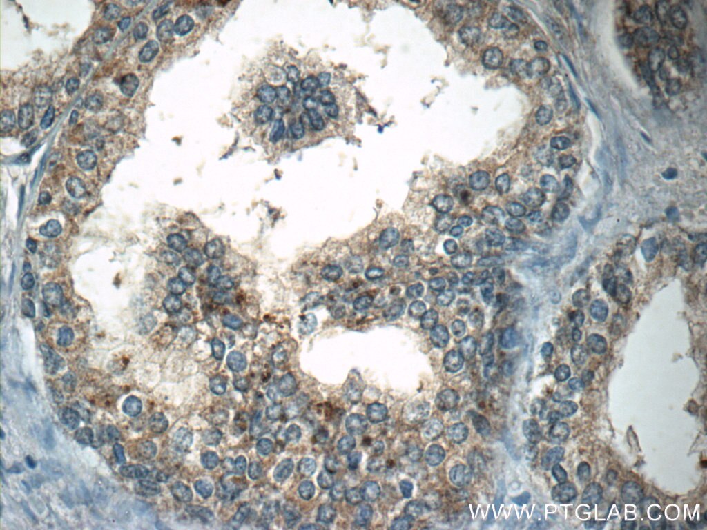 Immunohistochemistry (IHC) staining of human prostate hyperplasia tissue using INHBC Polyclonal antibody (24196-1-AP)