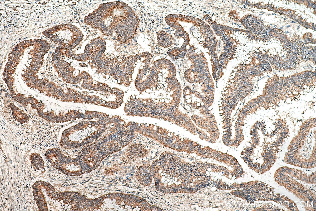IHC staining of human colon cancer using 18810-1-AP