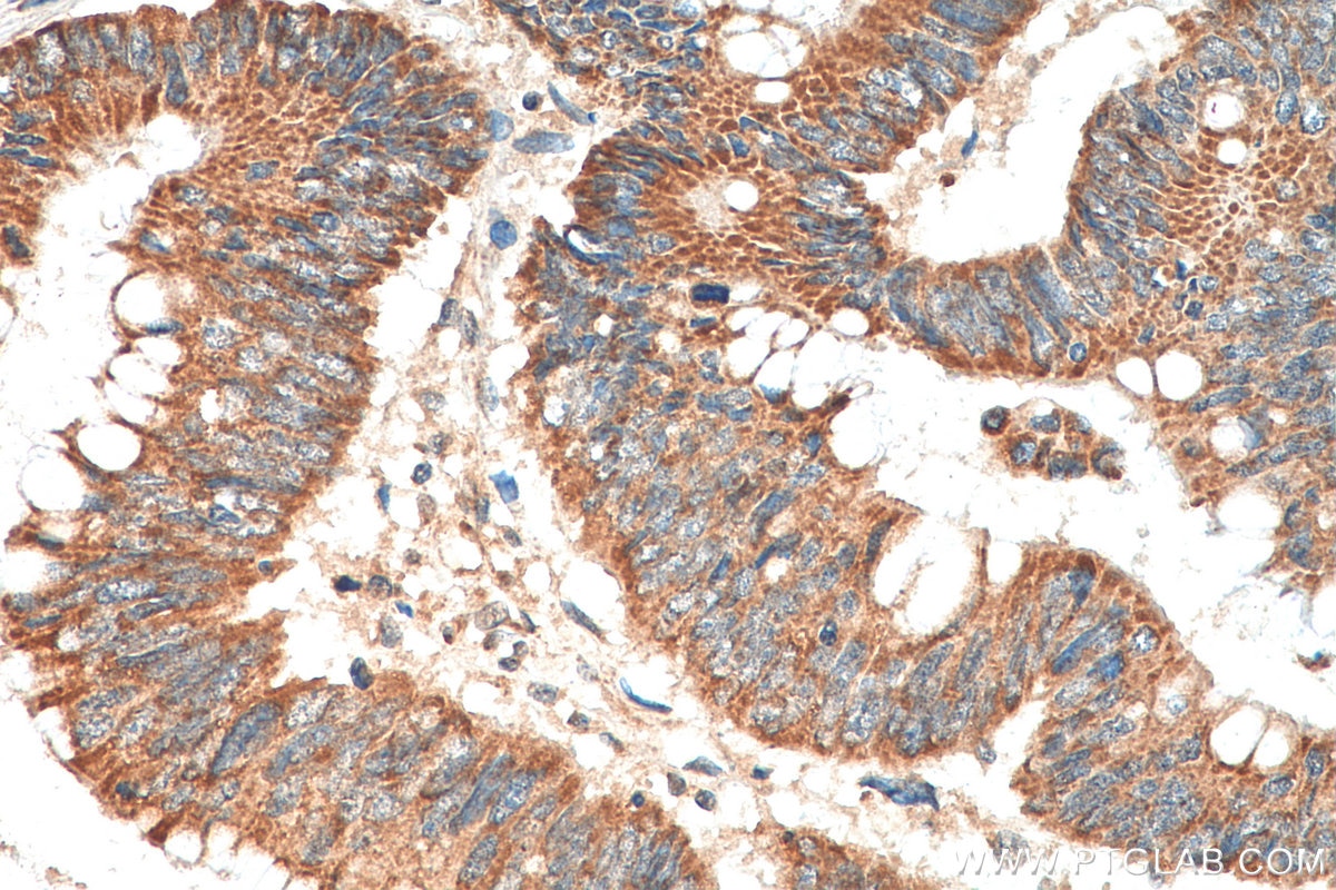 Immunohistochemistry (IHC) staining of human colon cancer tissue using INO80 Polyclonal antibody (18810-1-AP)