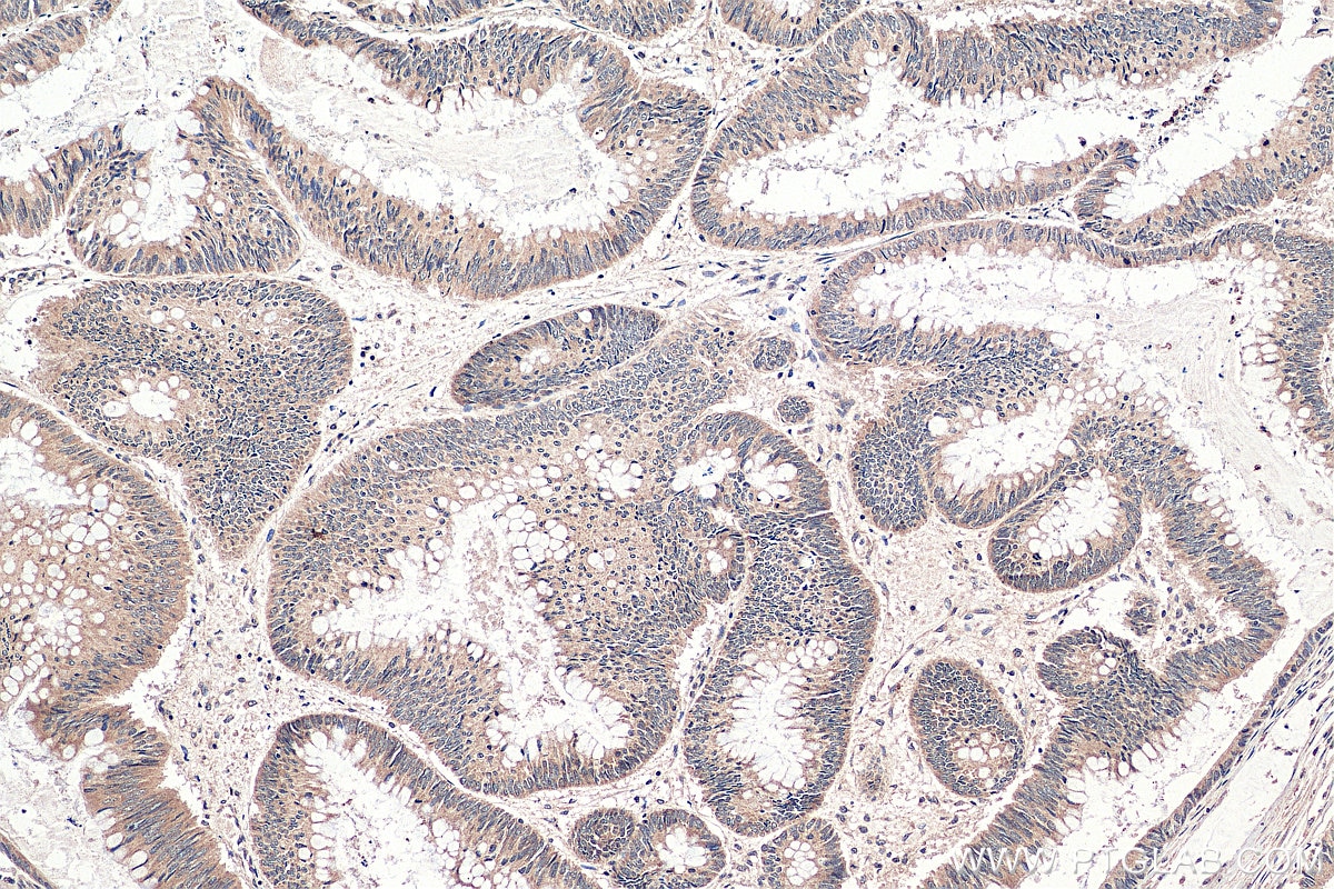 Immunohistochemistry (IHC) staining of human colon cancer tissue using INO80 Polyclonal antibody (24819-1-AP)