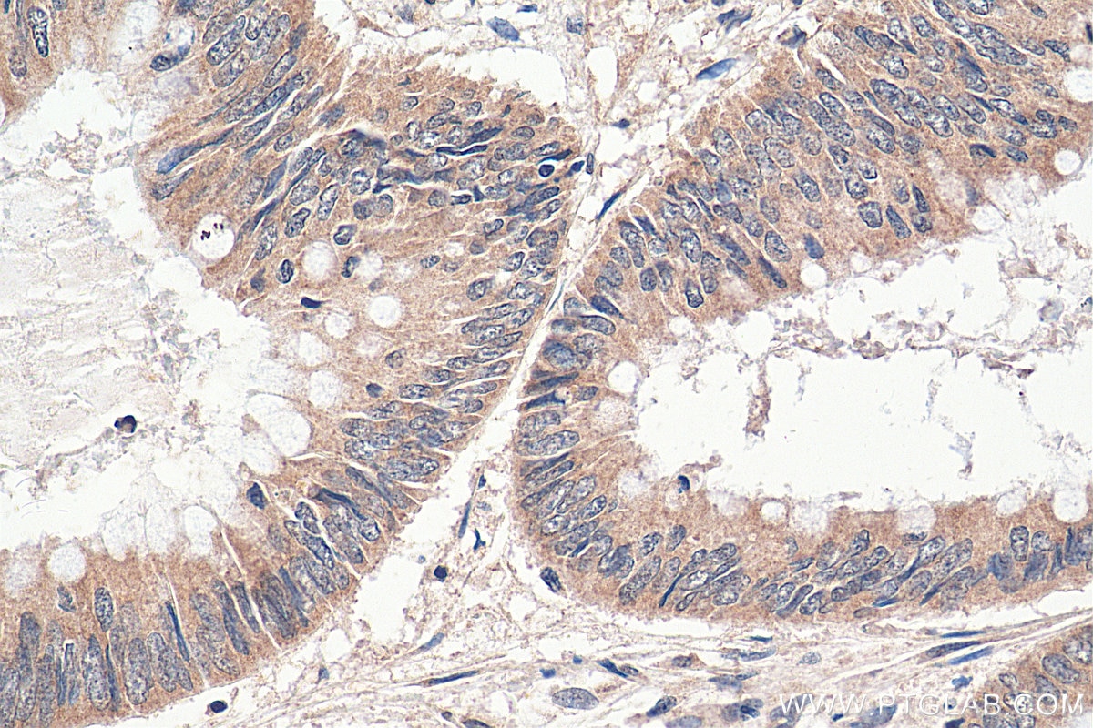 Immunohistochemistry (IHC) staining of human colon cancer tissue using INO80 Polyclonal antibody (24819-1-AP)