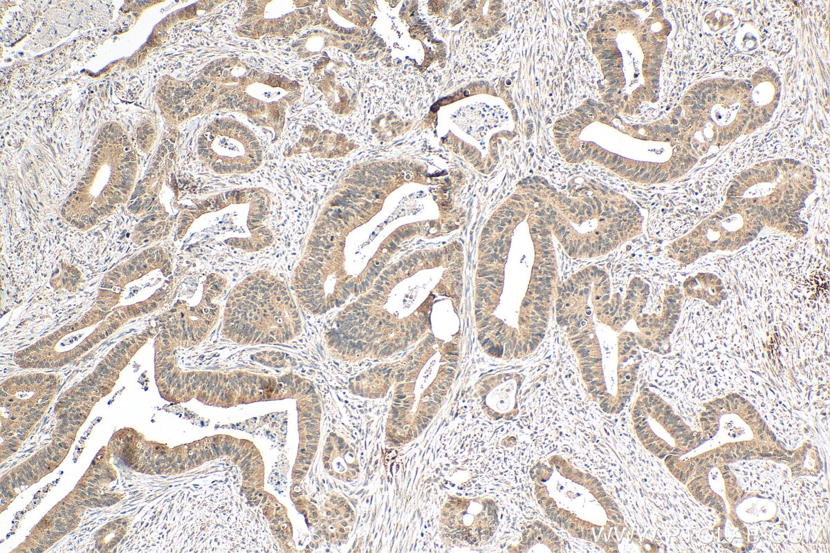 IHC staining of human colon cancer using 68064-1-Ig