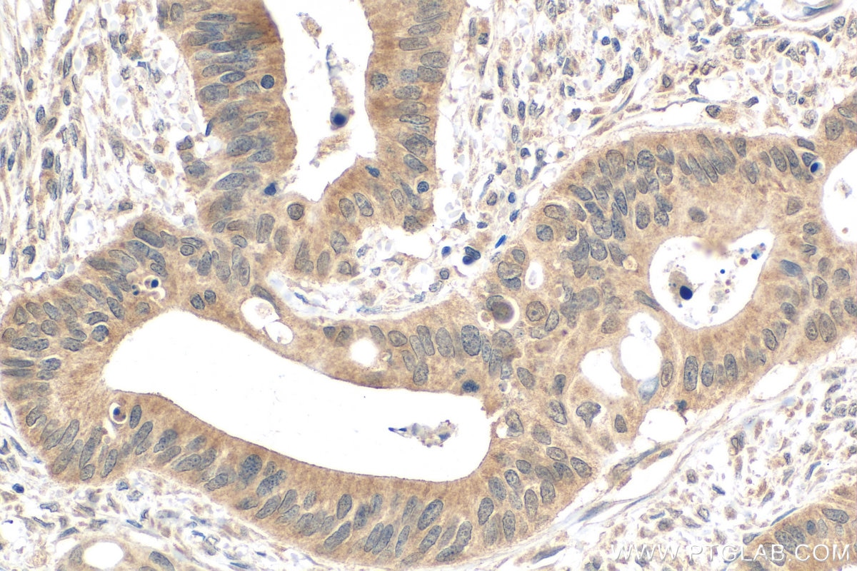 IHC staining of human colon cancer using 68064-1-Ig