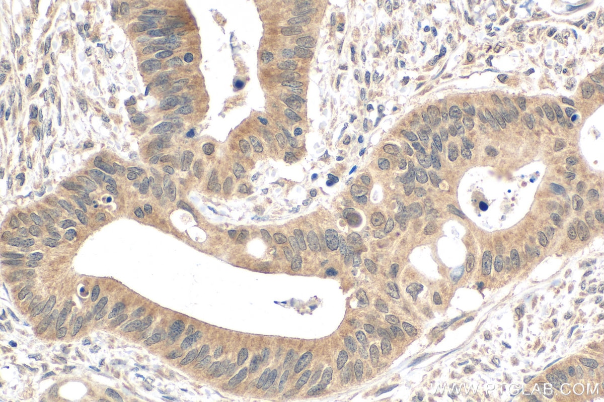 Immunohistochemistry (IHC) staining of human colon cancer tissue using INO80 Monoclonal antibody (68064-1-Ig)