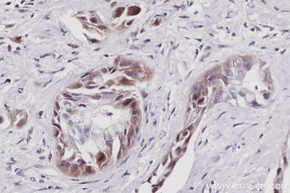Immunohistochemistry (IHC) staining of human pancreas cancer tissue using INO80 Recombinant monoclonal antibody (83117-4-RR)