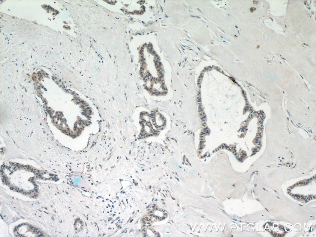 Immunohistochemistry (IHC) staining of human breast cancer tissue using INO80C Polyclonal antibody (24793-1-AP)