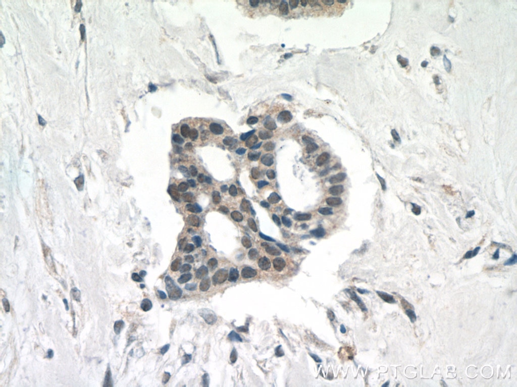 Immunohistochemistry (IHC) staining of human breast cancer tissue using INO80C Polyclonal antibody (24793-1-AP)