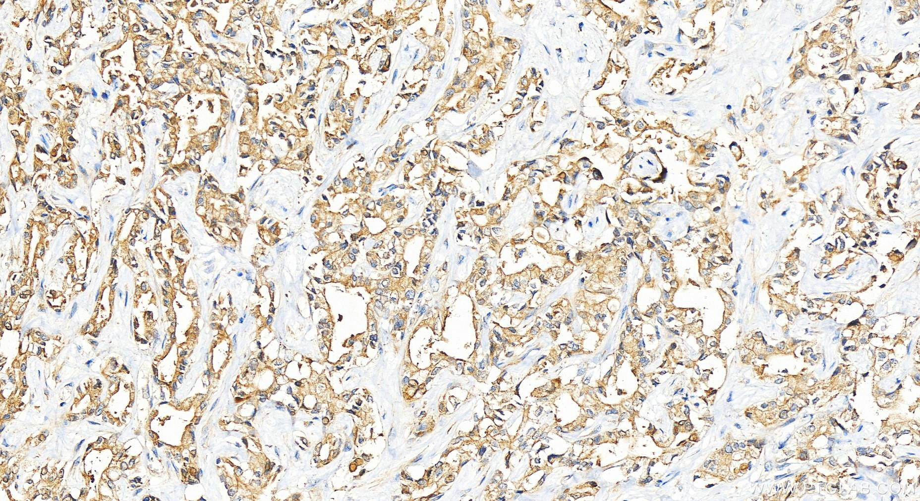 Immunohistochemistry (IHC) staining of human intrahepatic cholangiocarcinoma tissue using INPP4A Polyclonal antibody (12665-1-AP)