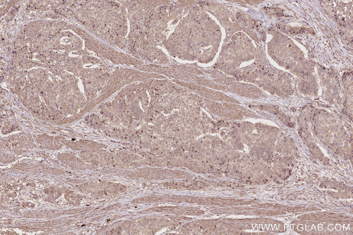 IHC staining of human stomach cancer using 12665-1-AP Immunohistochemistry (IHC) staining of human stomach cancer tissue using INPP4A Polyclonal antibody (12665-1-AP)