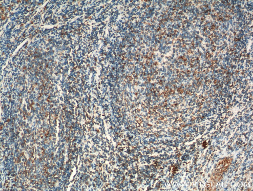 IHC staining of human tonsillitis using 19694-1-AP