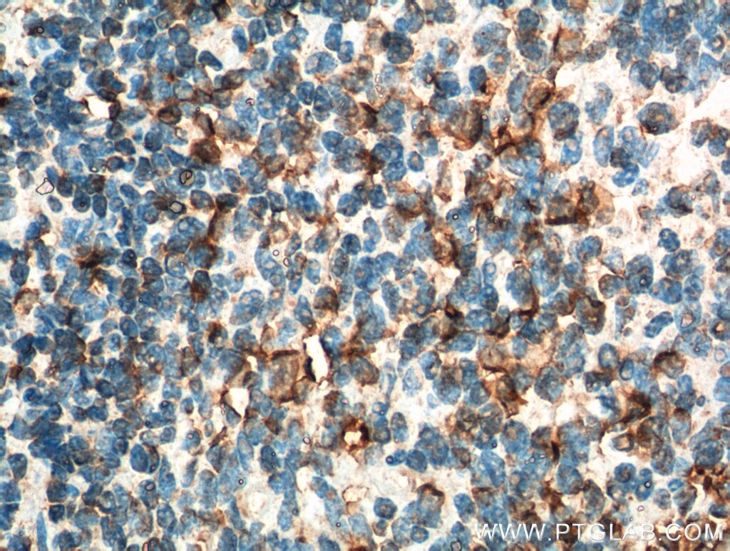 Immunohistochemistry (IHC) staining of human tonsillitis tissue using INPP5D Polyclonal antibody (19694-1-AP)